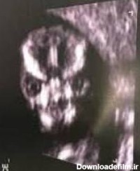 وحشت مادر از عکس سونوگرافی جنین داخل شکمش + عکس