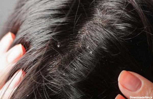 شپش موی سر و نحوه درمان آن چیست ؟ - کلینیک لاجوردی