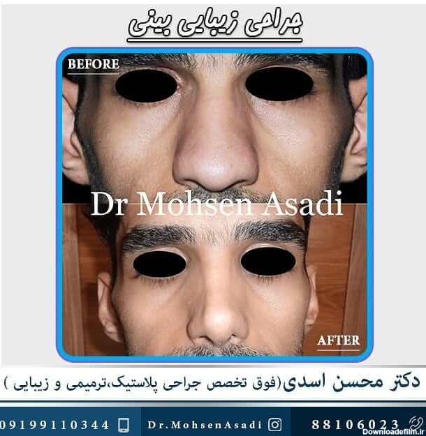 نمونه جراحی بینی گوشتی دکتر محسن اسدی