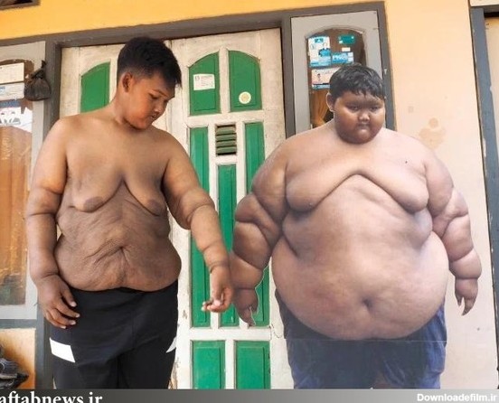 تصاویر| چاق‌ترین پسر جهان پس از جراحی و کاهش وزن