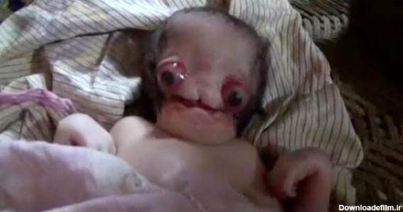 تولد ترسناک ترین نوزاد عجیب الخلقه در جهان!+عکس