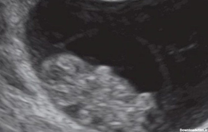 سونوگرای جنین در هفته هشتم بارداری