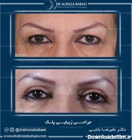 تصاویر جراحی پلک | عکس عمل زیبایی چشم – دکتر علیرضا بابایی