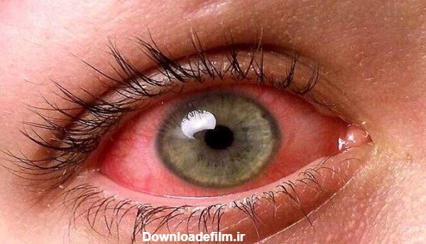 اگر قرمزی چشم دارید، چه زمانی باید به چشم پزشک مراجعه کنید ...