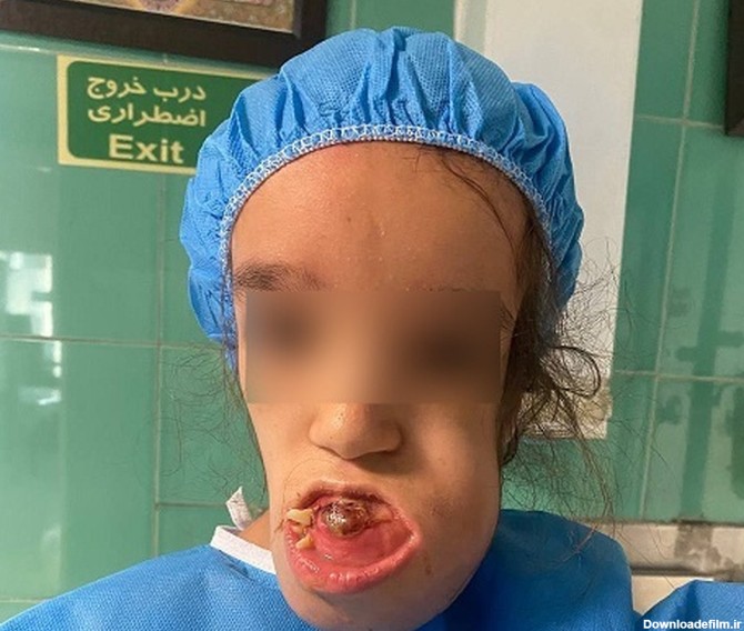 شاهکار پزشکان ایرانی: جراحی منحصر به فرد دختر 11 ساله در بیمارستان مفید (به همراه تصاویر +16)