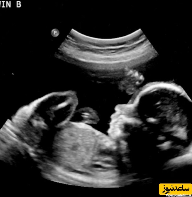 (عکس) نگه داری جنین های سقط شده داخل نایلون توسط مادر عاشق / چند تا بچه سقط کردی مگه؟!