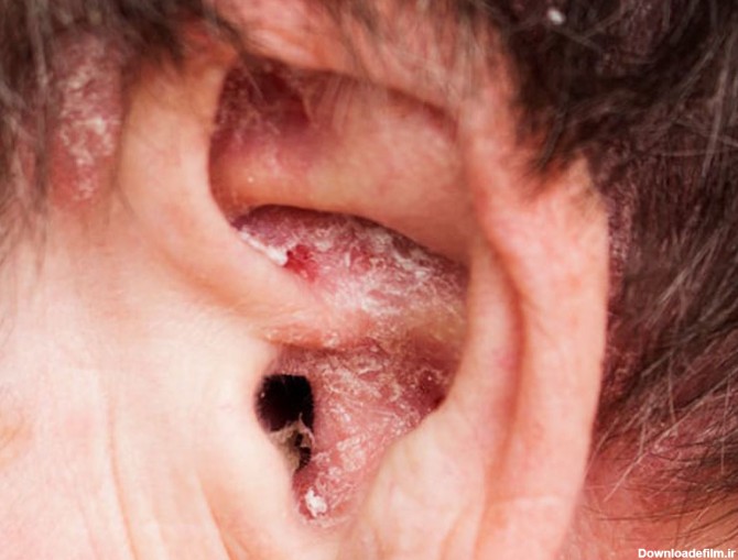 اگزمای لاله گوش چه علائمی دارد؟ چگونه می توان آن را درمان کرد؟
