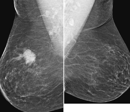 پیشگیری از سرطان پستان با غربالگری به موقع با ماموگرافی ...