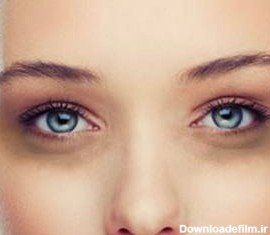 علل سیاهی دور چشم و راههای درمان دائم سیاهی و کبودی اطراف چشم