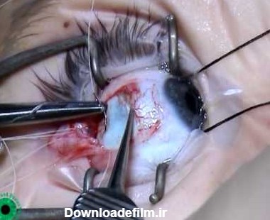 جراحی انحراف چشم