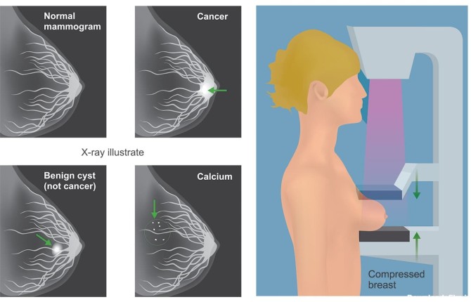 ماموگرافی را جدی بگیرید | موسسه تصویر برداری نسيم پرتو