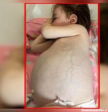 زایمان عجیب دختر 7 ماهه ! + عکس +16/وجود جنین زنده در بدن کودک