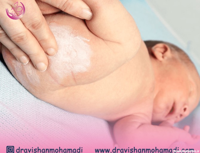 عفونت ‌های قارچی نوزادان | درمان عفونت های قارچی در نوزادان | علل ...