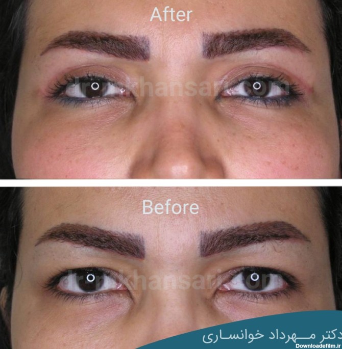 تصاویر عمل پلک چشم - نمونه واقعی عکس قبل و بعد - دکتر خوانساری