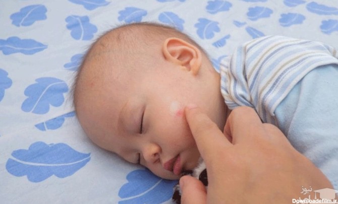 علل قارچ پوستی در کودکان و راههای درمان آن