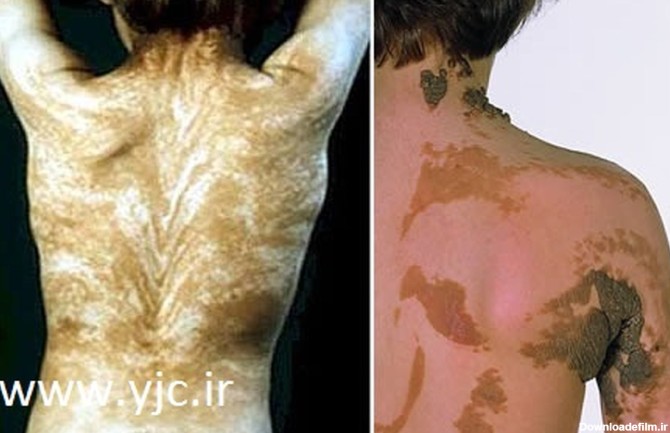 عجیب ترین بیماری های پوستی / عکس