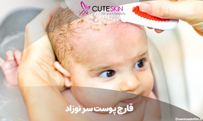 قارچ پوست سر نوزاد؛ علائم، علل ایجاد و راه درمان - کیوت مگ | CuteSkin