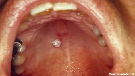 زگیل دهانی + {درمان و روشهای انتقال زگیل زبان} | کلینیک زارعی