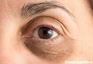 علت‌ها و روش‌های درمان سیاهی دور چشم - خبرآنلاین