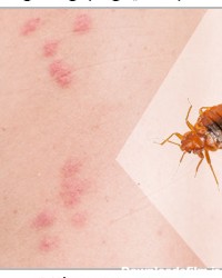 تشخیص گزش ساس از گزیدگی سایر حشرات و راه های درمان آن | میهن سم
