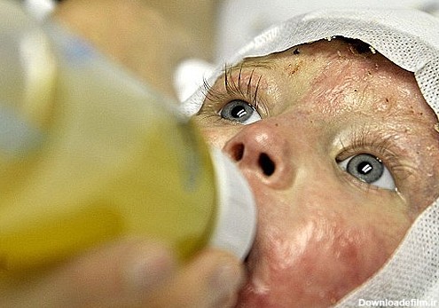 نخستین تصاویر کودکی پس از پیوند پوست/ بهبود پس از 80درصد سوختگی ...