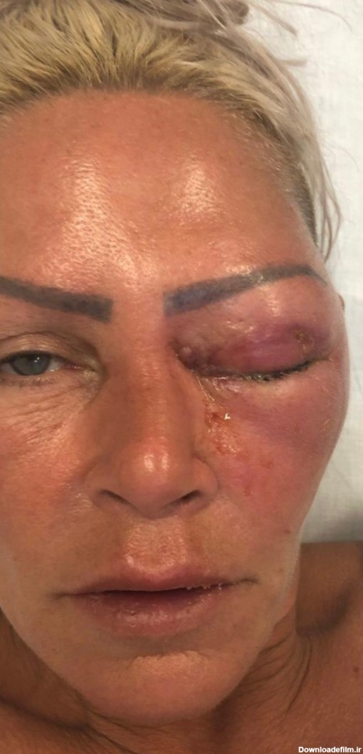 عواقب وحشتناک جراحتی کوچک در چشم زن ۴۷ ساله + عکس