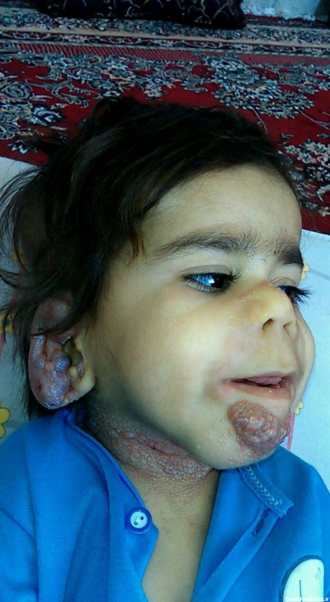 این بیماری در ایران فقط یک بیمار دارد/ عکس - خبرآنلاین