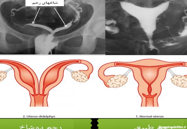 ضرر عکس رنگی رحم