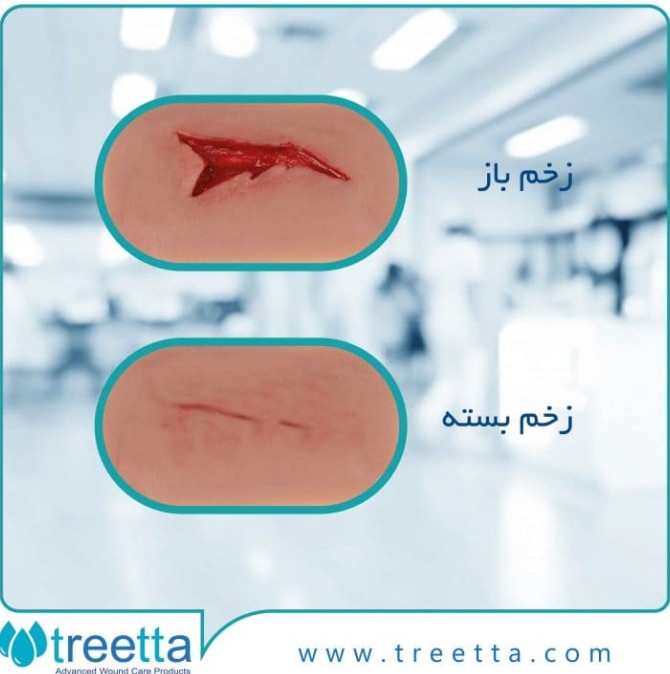 زخم چیست؟ انواع زخم + درمان زخم | ترمیم زخم - تریتا