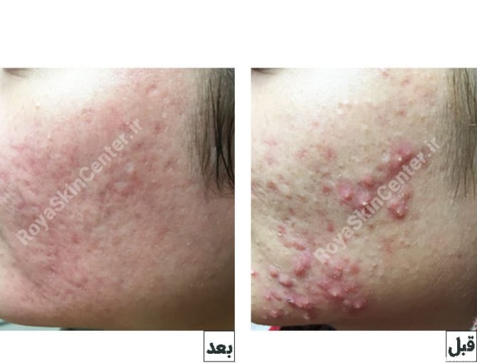درمان و جوانسازی با لیزر CO2 + عکس قبل و بعد - کلینیک پوست ...
