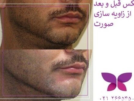 زاویه دار کردن صورت مردان با تزریق ژل ✔️ | مرکز زیبایی و لیزر