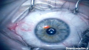عمل "لیزیک چشم" چگونه انجام می شود؟ +فیلم