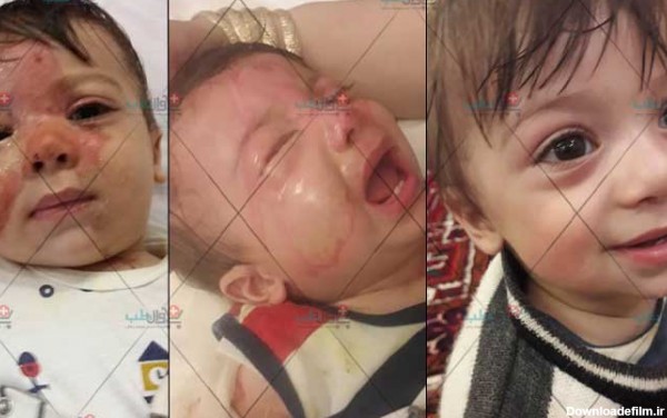 گزارش یک مورد درمان زخم سوختگی با آب جوش کودک سه ساله - وبلاگ وان طب