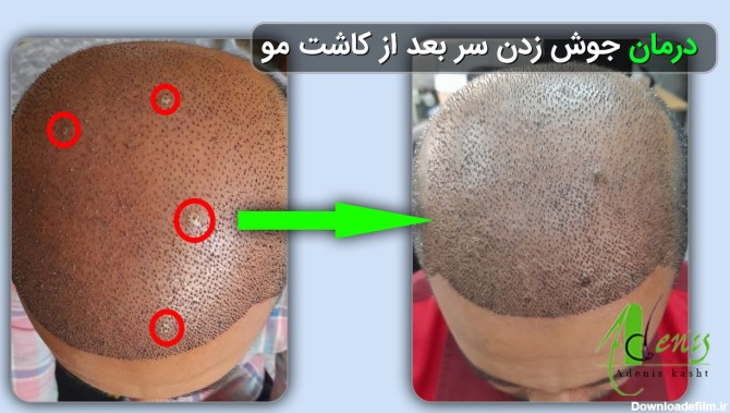 عکس عفونت سر بعد از کاشت مو