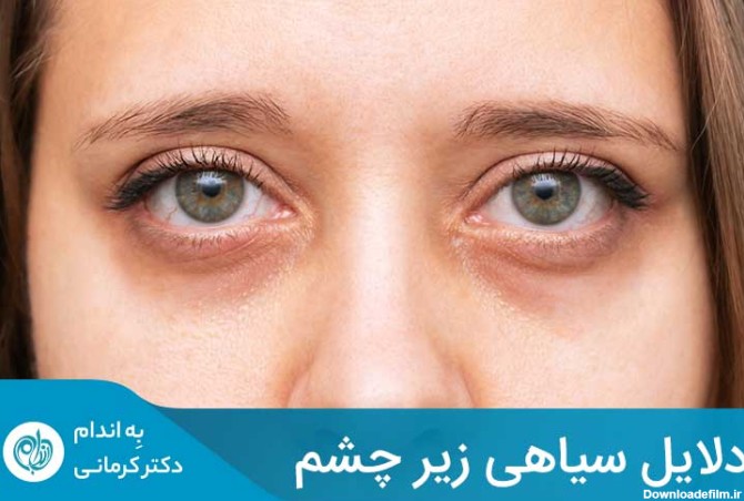 سیاهی زیر چشم چه دلایلی دارد و بهترین درمان آن چیست؟ | دکتر کرمانی