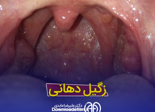 درمان زگیل دهانی + عکس زگیل دهانی 1402 و زگیل زبان