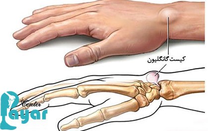 کیست گانگلیون مچ دست چیست؟ (علائم و درمان آن) - کلینیک پایار