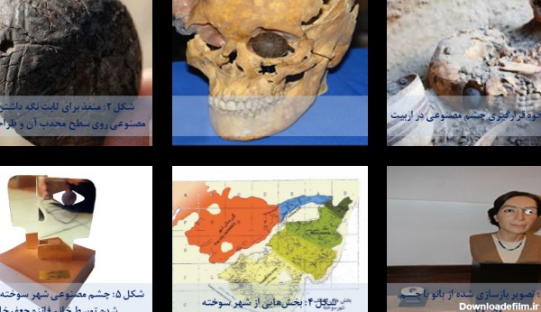 چشم مصنوعی شهر سوخته - اسناد چشم‌‌پزشکی فارسی