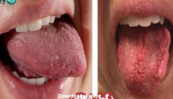 زگیل دهانی چیست؟ عوامل خطر، تشخیص و درمان HPV در دهان | کلینیک پایتخت