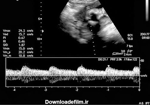 ضربان قلب نرمال جنین در دوران بارداری - سونوگرافی و رادیولوژی صدرا