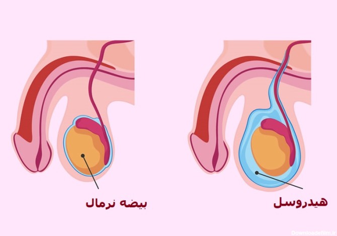 هیدروسل بیضه در کودکان، عکس ورم بیضه در کودکان | دکتر حسین کرمی