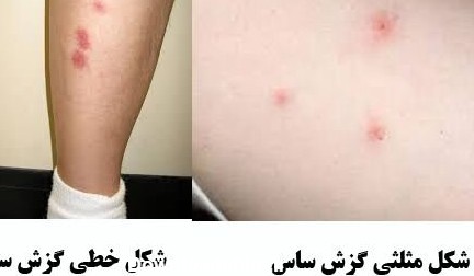 تشخیص انواع جای گزش حشرات و راههای مقابله با اًنها / عکس