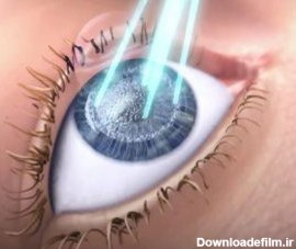 لیزر اگزایمر - کلینیک چشم پزشکی پارسیان