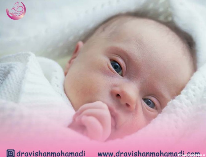 سندروم داون | تشخیص سندروم داون در دوران جنینی | دکتر آویشن محمدی