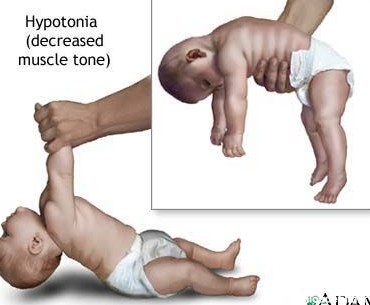 تشخیص سندرم داون در نوزاد - سلامت بانوان اوما