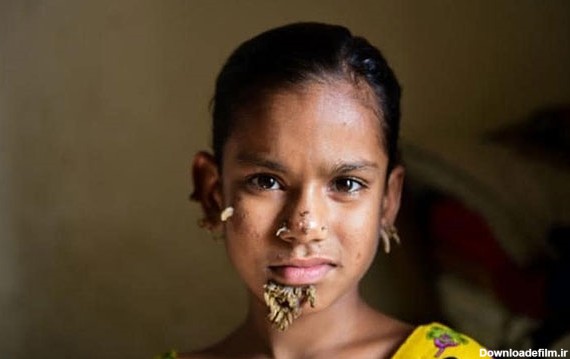 تصاویر نخستین «دختر درختی» در جهان/ تلاش پزشکان برای درمان ...