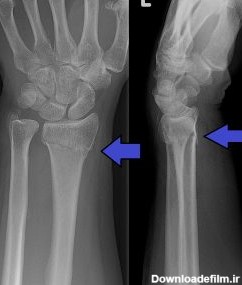فیزیوتراپی در شکستگی مچ دست - کلینیک فیزیوتراپی نوین طب
