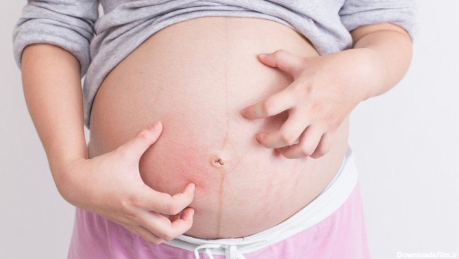 کهیر بارداری چیست؟ روش تشخیص + علت بروز آن - درمانکده