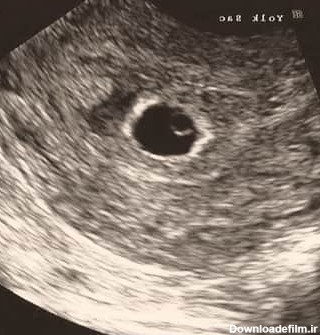 سونوگرافی در هفته پنجم بارداری