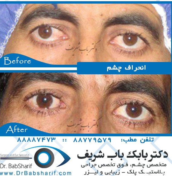 عکس‌های جراحی انحراف چشم | دکتر بابک باب شریف